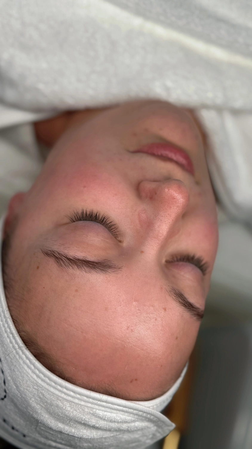 Bebe Aesthetics – Beauty & SPA – Microneedling