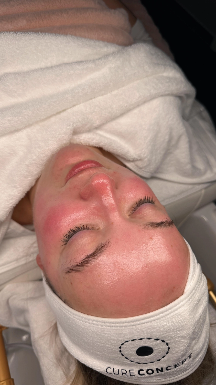 Bebe Aesthetics – Beauty & SPA – Microneedling